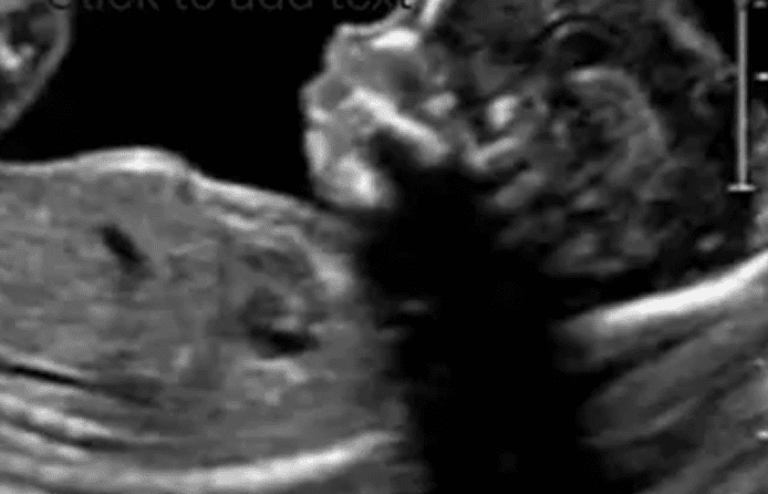 Ultrasound image of a developing fetus.