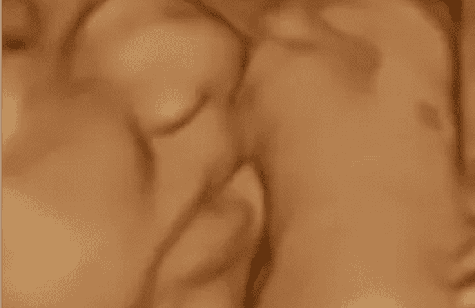 3D ultrasound image of a developing fetus.