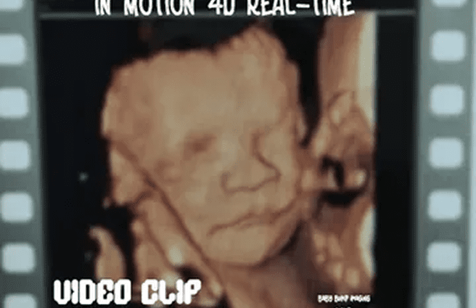4D ultrasound image of a baby.